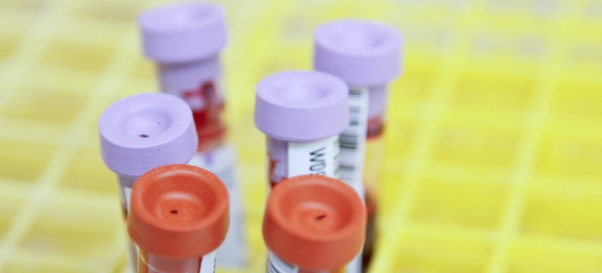 Țintă terapeutică pentru leucemia mieloidă acută, propusă în urma unui nou studiu