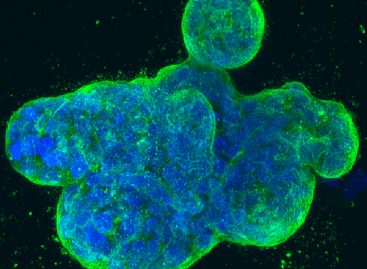 Proteine din cancerul de sân ar putea estima sensibilitatea la chimioterapie