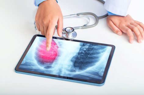 În România, un bărbat din 15 riscă să fie diagnosticat cu cancer pulmonar, până face 75 de ani