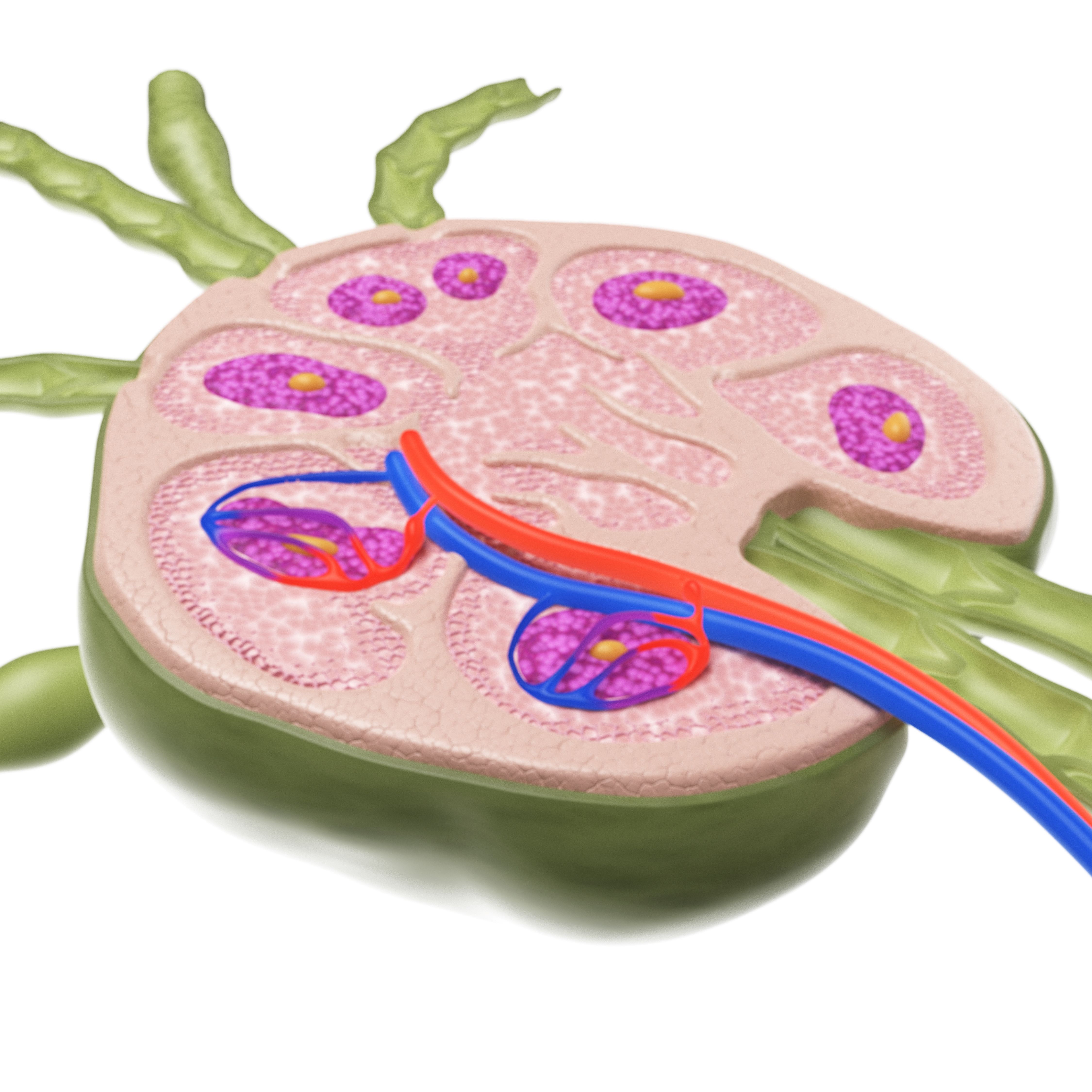 Ganglion limfatic artificial pentru tratarea cancerului, dezvoltat de cercetători