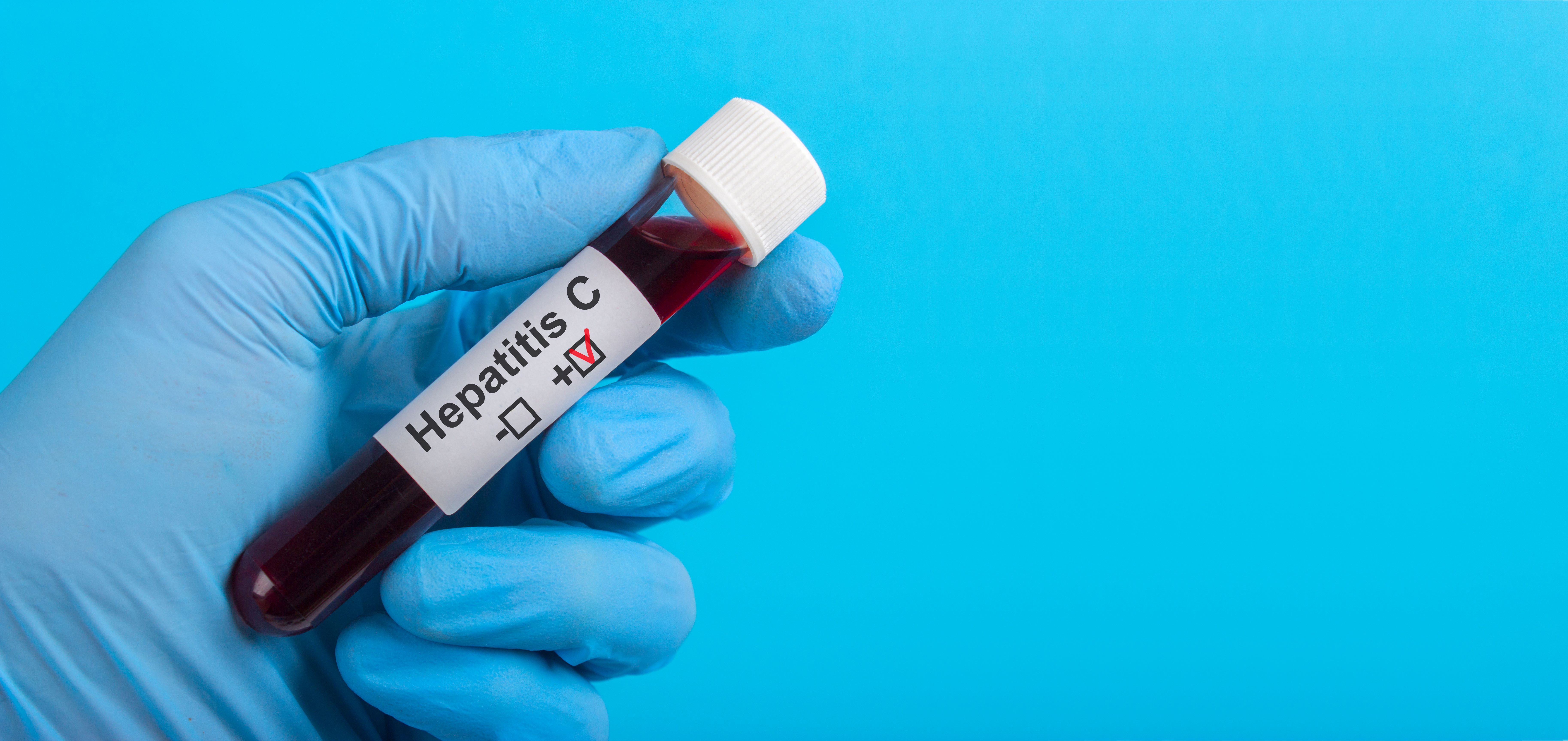 Anglia ar putea deveni prima țară care elimină virusul hepatitei C