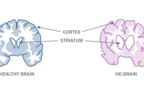 Un studiu considerat revoluţionar indică un posibil tratament pentru boala Huntington