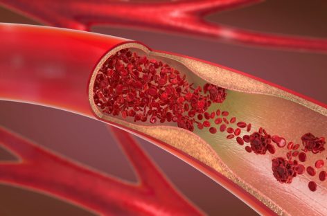 Diagnosticul şi tratamentul trombozei venoase profunde, la Spitalul Clinic SANADOR