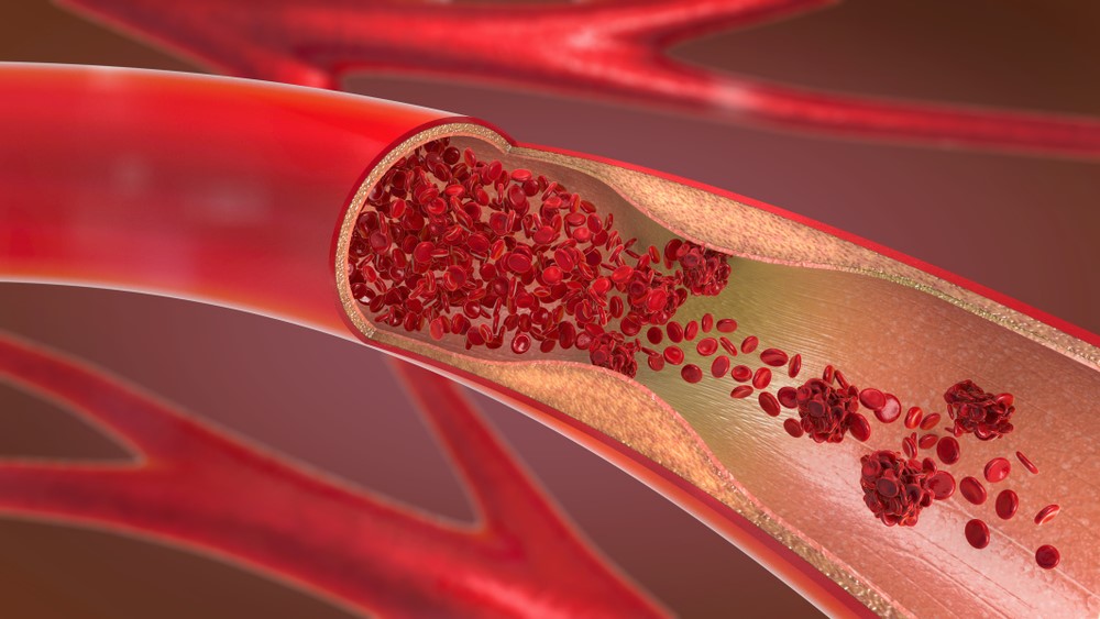 Diagnosticul şi tratamentul trombozei venoase profunde, la Spitalul Clinic SANADOR