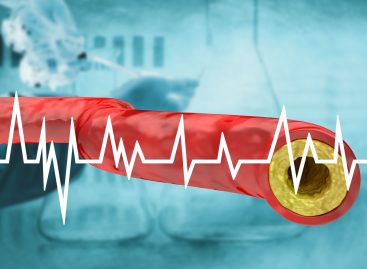 Radiomica folosită pentru a estima riscul de infarct miocardic