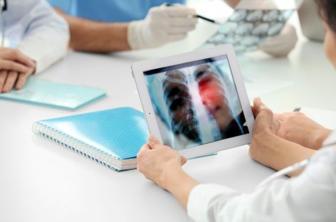 O imunoterapie testată împotriva cancerelor pulmonare, rezultate slabe în testele finale