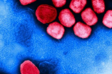 Formă severă de mpox identificată în cazurile avansate de HIV