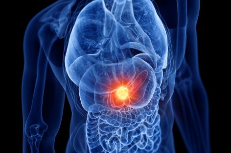 Biomarkeri pentru identificarea timpurie a riscului de cancer pancreatic