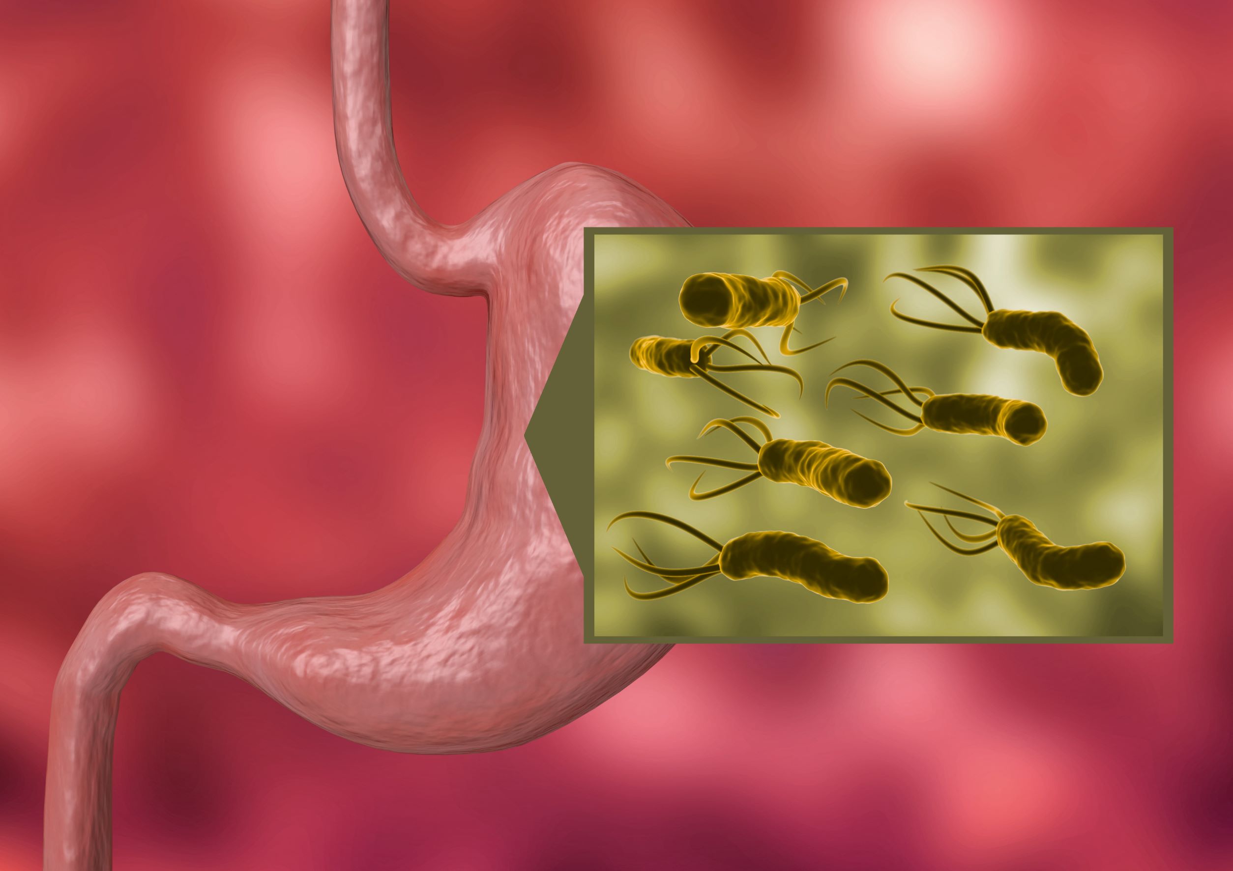 Progrese în lupta împotriva Helicobacter şi a cancerului de stomac