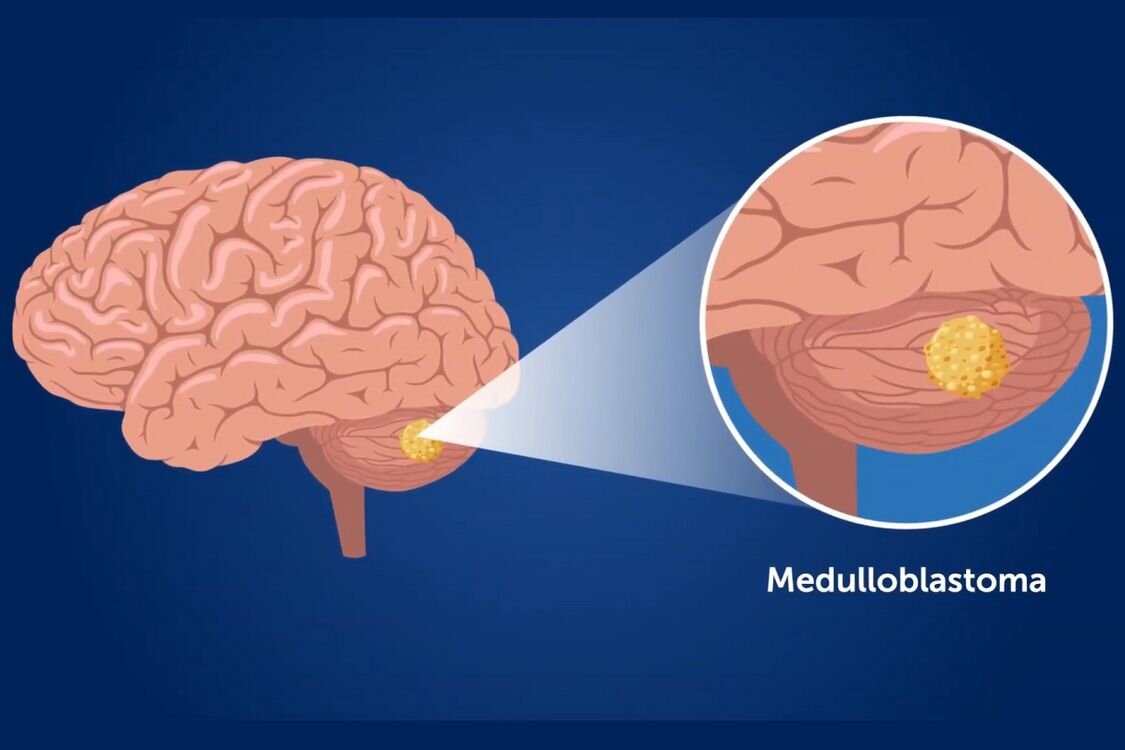 VIDEO Consecinţe serioase identificate pentru tinerii supravieţuitori ai cancerului cerebral