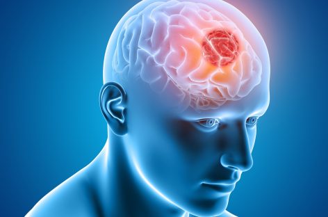 Progrese majore în vindecarea tumorilor cerebrale