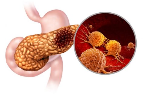 Tratamentul multimodal al cancerului pancreatic, la Centrul Oncologic SANADOR