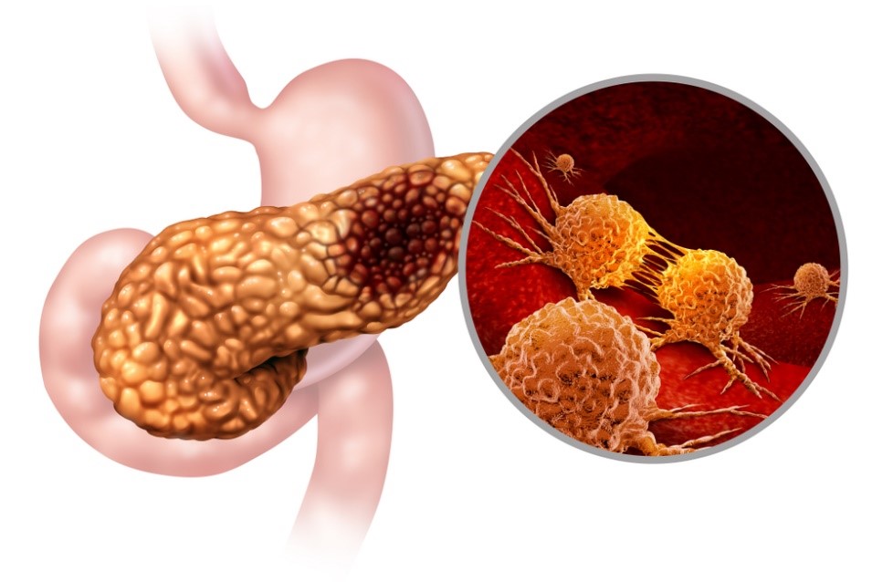 Tratamentul multimodal al cancerului pancreatic, la Centrul Oncologic SANADOR