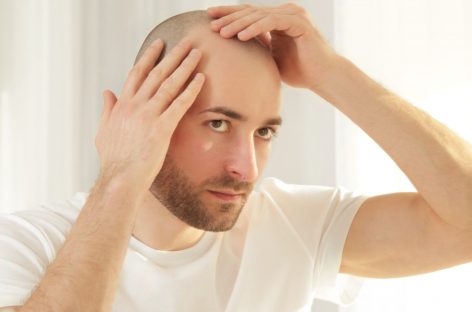 Un medicament destinat tratării căderii părului provocată de o boală autoimună, autorizat în SUA