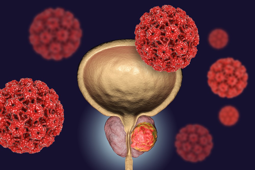 Metode performante de screening şi diagnostic pentru cancerul de prostată la SANADOR