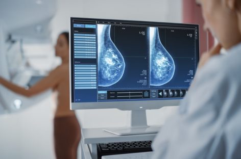 Screening şi diagnostic avansat pentru cancerul mamar, la SANADOR