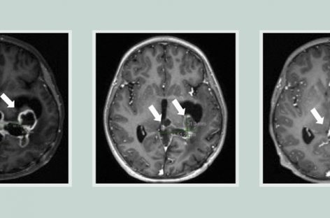 Medicament experimental, testat clinic pentru tratarea tumorilor cerebrale agresive