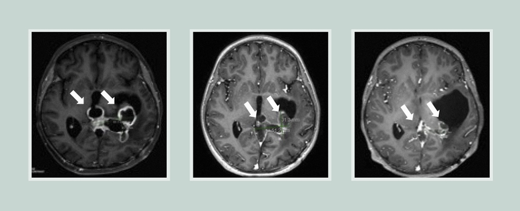 Medicament experimental, testat clinic pentru tratarea tumorilor cerebrale agresive