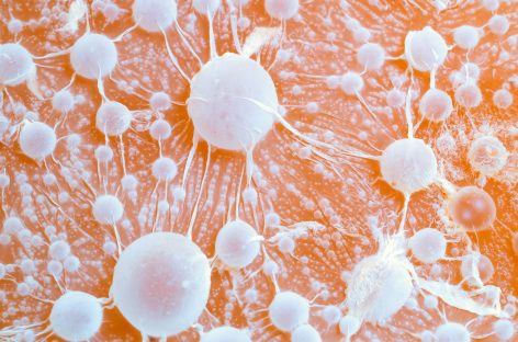 Oamenii de știință au identificat pe celulele canceroase o proteină care susține răspunsul imunitar împotriva tumorilor