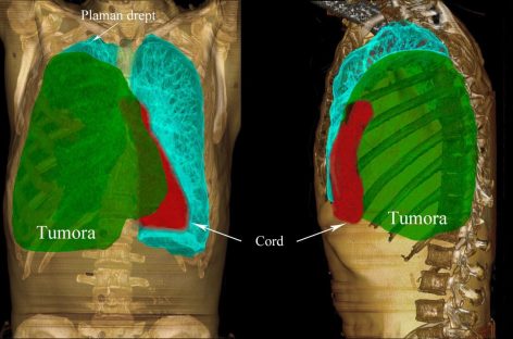 Tumoră pleurală gigant, eliminată cu succes la Spitalul Universitar din Capitală