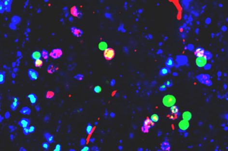 Nanoparticulele de plastic din mediu, legate de modificări ale proteinelor din creier asociate cu boala Parkinson