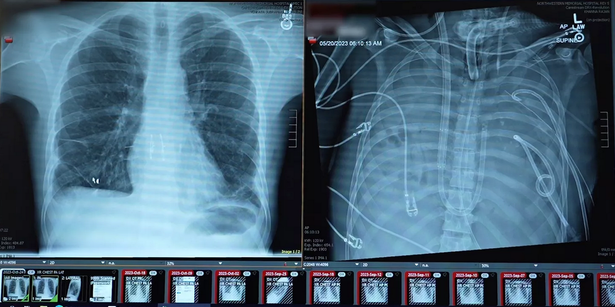 Implanturi mamare folosite într-o procedură inovatoare în SUA pentru salvarea unui tânăr cu leziuni pulmonare grave