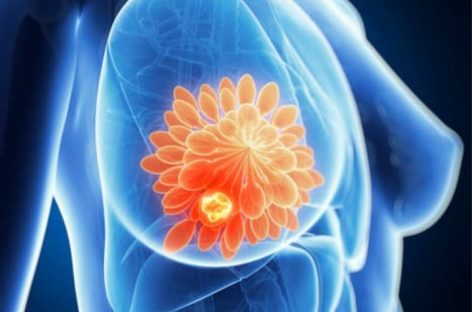 O nouă opțiune de tratament pentru cancerul de sân, autorizată în SUA