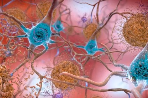 Cercetătorii au identificat mai multe proteine care pot indica semnele demenței și cu 15 ani înainte de diagnostic