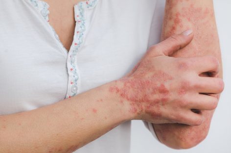 Dermatologia şi sănătatea mintală: Un studiu leagă psoriazisul de tulburarea obsesiv-compulsivă