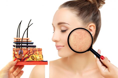 Cercetătorii au reușit să modifice bacteriile responsabile de apariția acneei pentru a trata această afecțiune a pielii