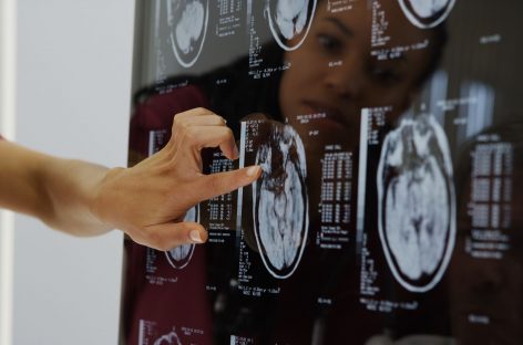 Prima dovadă raportată a maladiei Alzheimer posibil dobândită pe cale medicală