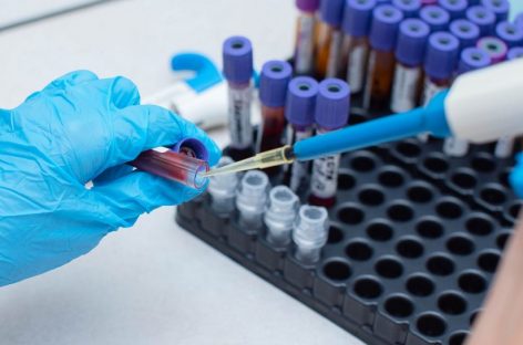 Tehnică nouă pentru detectarea biomarkerilor în bolile renale