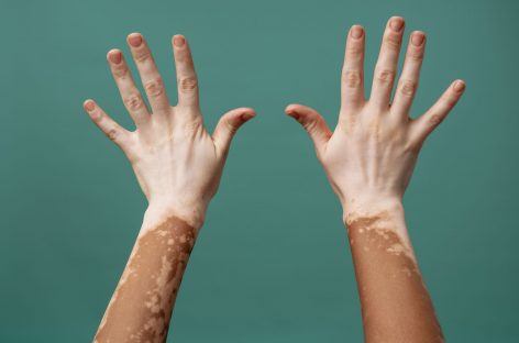 Adolescenţii cu vitiligo, rate mari de repigmentare decât adulţii cu un medicament testat într-un studiu pivot