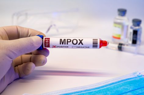 Kosovo a detectat primul său caz de mpox