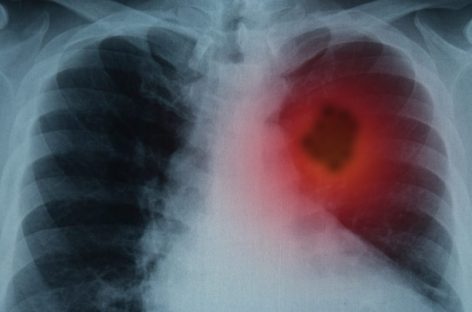 Ziua Mondială a Plămânilor: În România, 2,3 milioane de oameni suferă de o boală respiratorie, iar peste 80.000 mor în fiecare an din cauza acestor afecţiuni