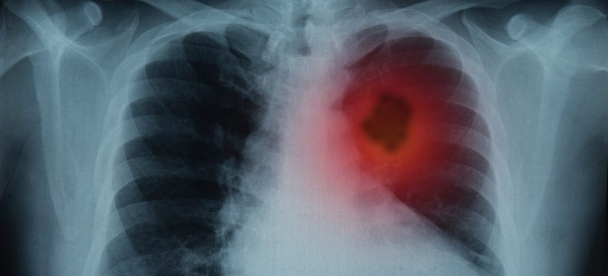 Ziua Mondială a Plămânilor: În România, 2,3 milioane de oameni suferă de o boală respiratorie, iar peste 80.000 mor în fiecare an din cauza acestor afecţiuni