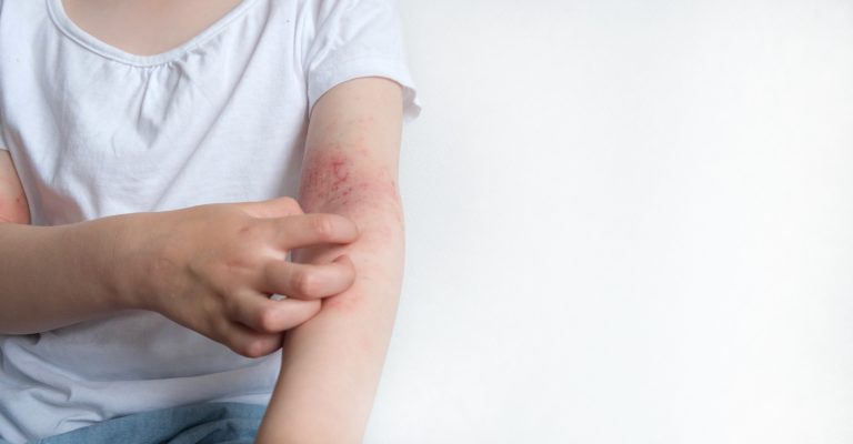 Afecţiunea de care suferă aproximativ 10% din români. Şase informaţii pe care nu le ştiai despre dermatita atopică