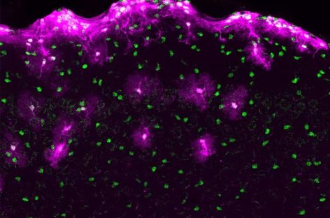 O nouă cercetare susţine transplantul de celule cerebrale ca tratament pentru unele afecţiuni neurologice