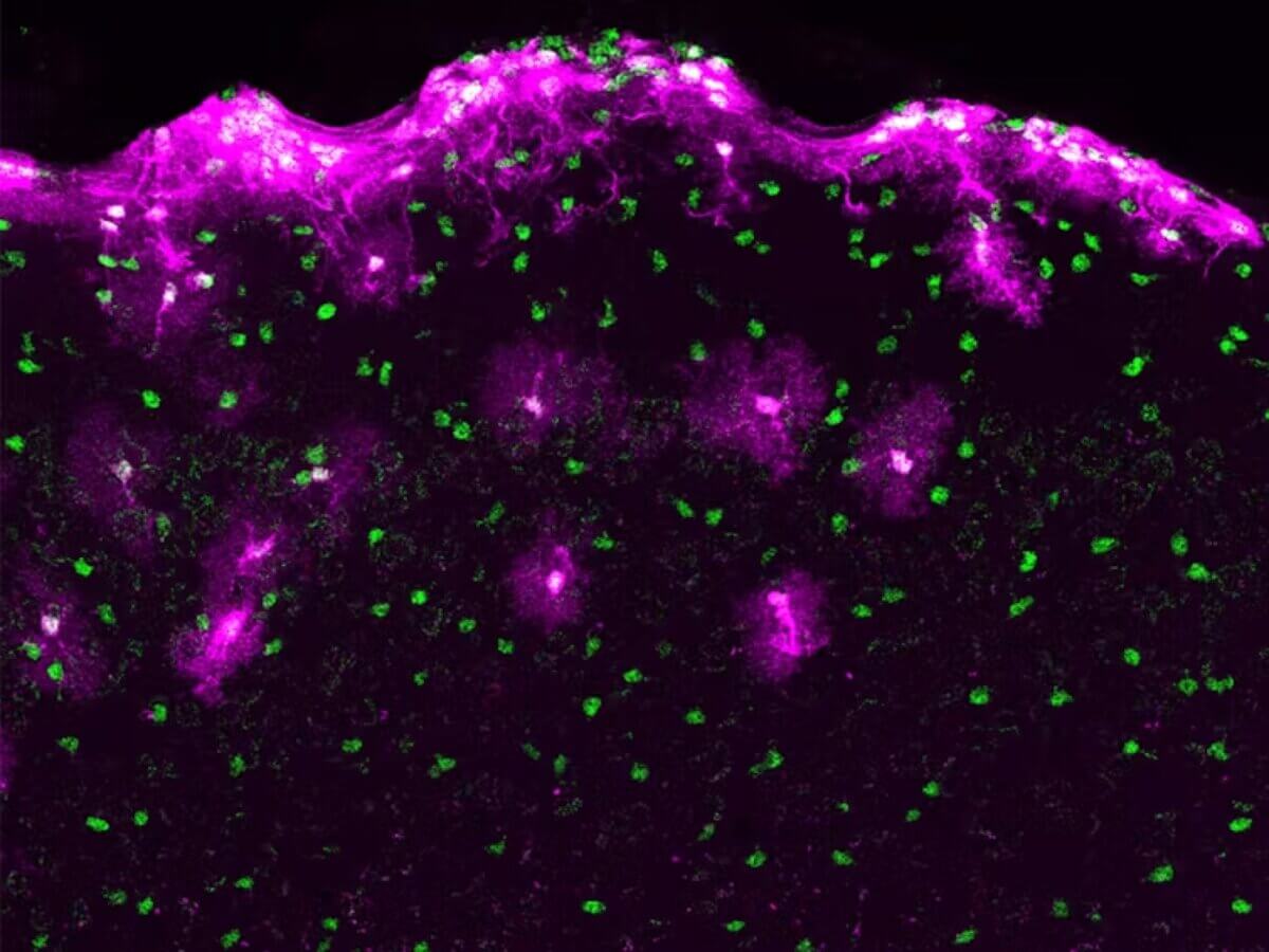 O nouă cercetare susţine transplantul de celule cerebrale ca tratament pentru unele afecţiuni neurologice