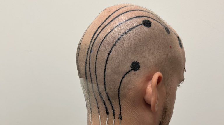 VIDEO Un tatuaj temporar imprimat direct pe scalp oferă o soluţie simplă pentru măsurarea undelor cerebrale